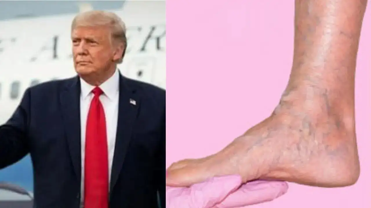 US President Donald Trump Diagnosed with Chronic Venous Insufficiency: Symptoms, Causes & Treatment
